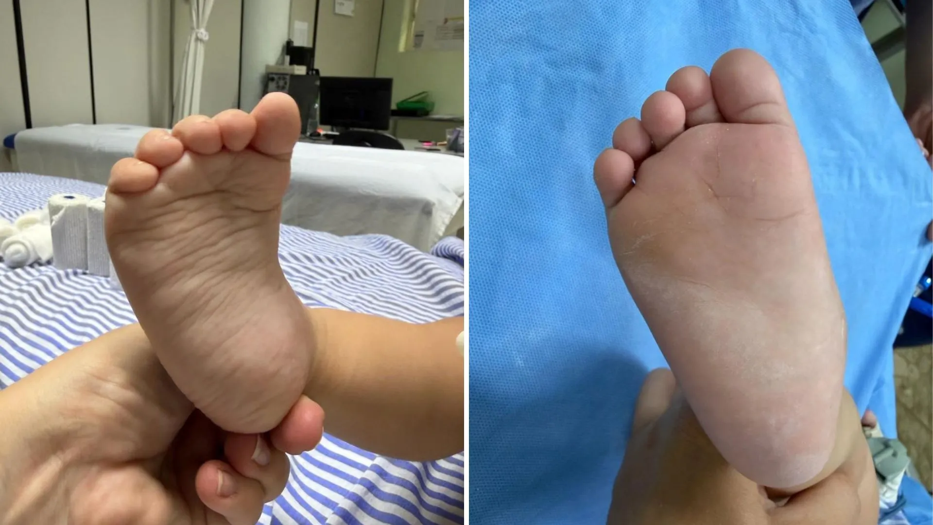 Mãe vê filha com síndrome do pé torto dar os primeiros passos durante tratamento pelo SUS: 'Inacreditável'